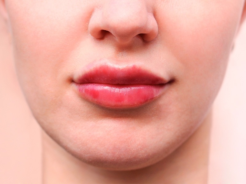5 основних причин появи висипу на губах